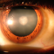 Cataract Statistics Cataract Statistics